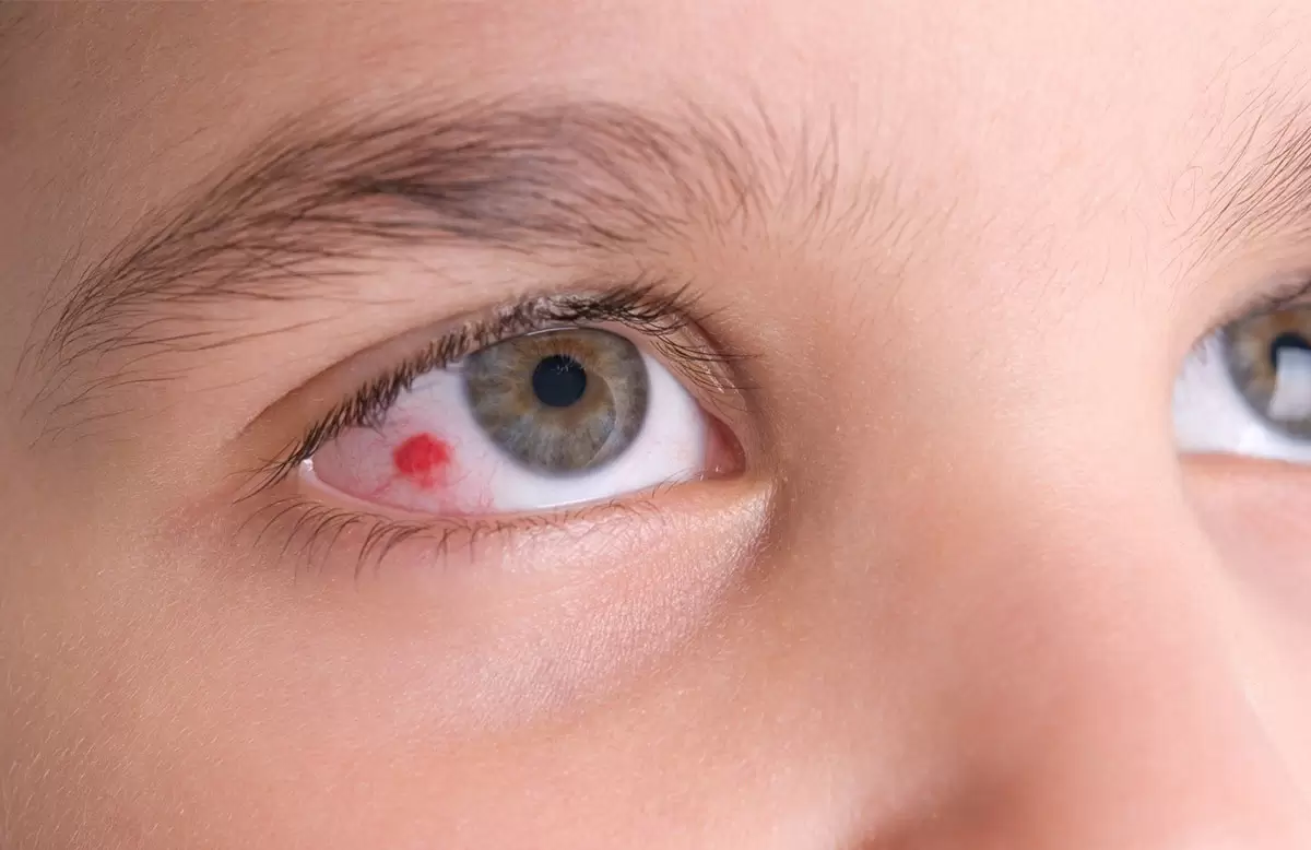 خونریزی کاسه چشم : علت و روش درمانی آن